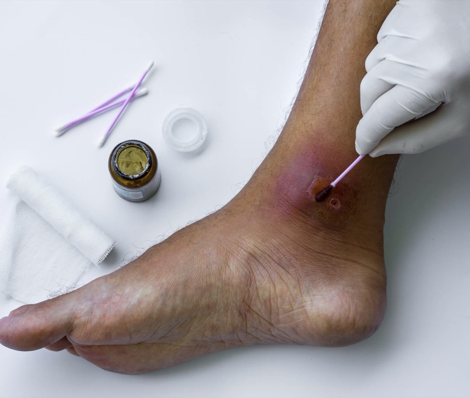 Eine Hand im Handschuh trägt mit einem Wattestäbchen Salbe auf eine offene Stelle am Innenknöchel auf