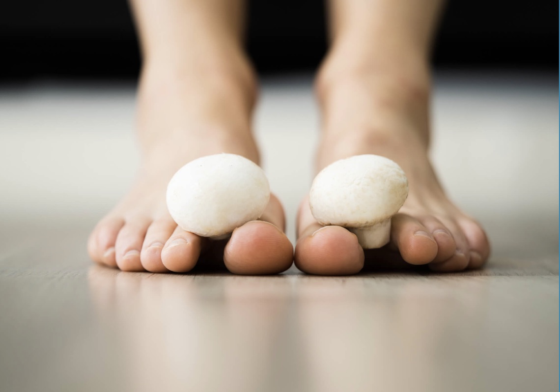 Zwei nackte Füße nebeneinander, zwischen den Zehen liegen Champignons – ein Sinnbild für Fußpilz