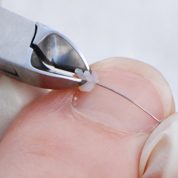 Nahaufnahme: Eine Nagelspange wird mit einem Instrument am Zehennagel angebracht